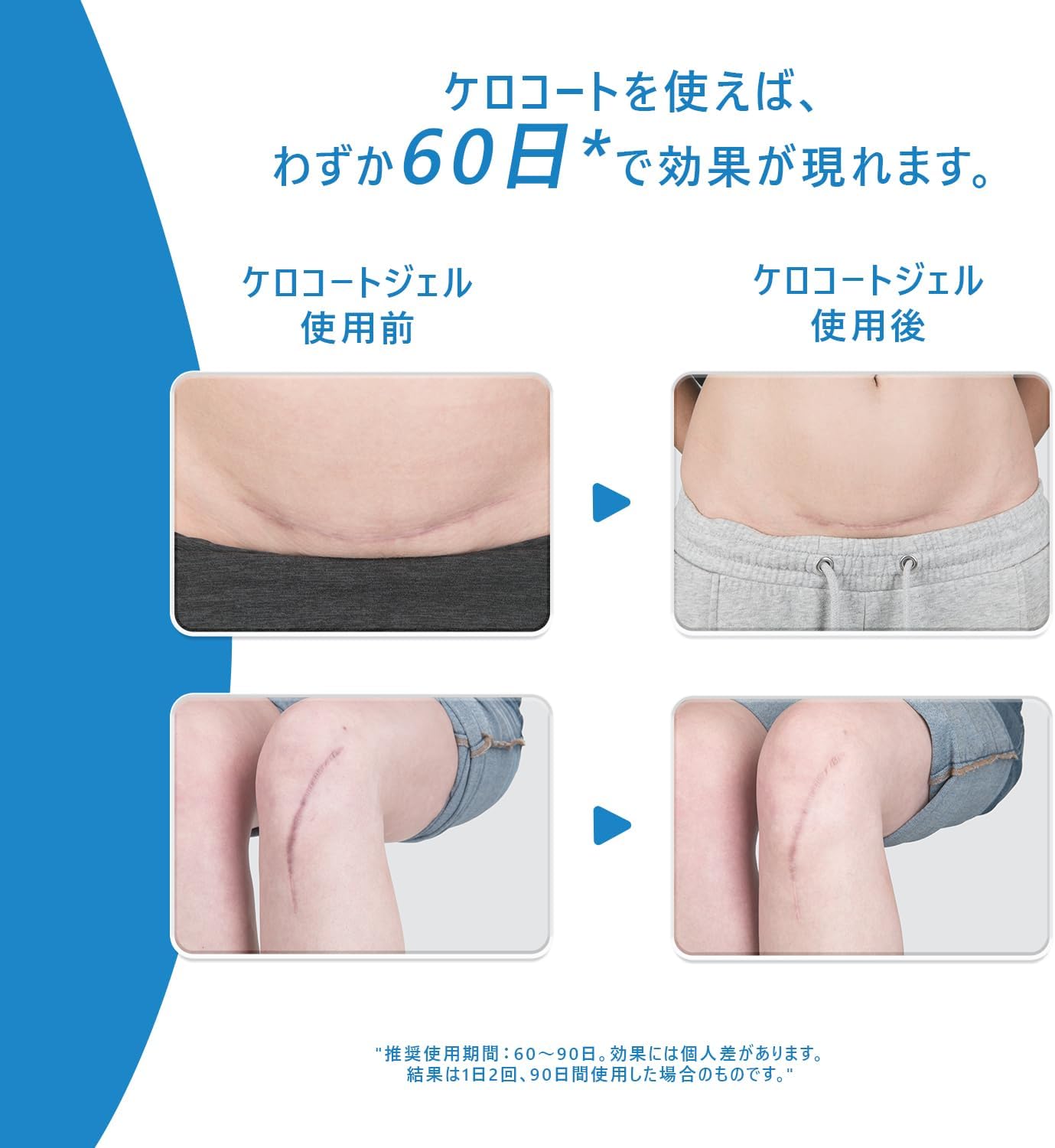 ケロコート6g｜医療用シリコンジェルで傷跡・ケロイドをケア