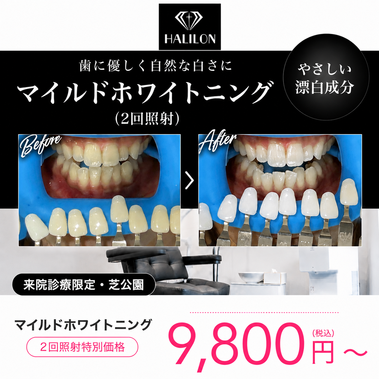 【HALILON Oral Studio】来院診療｜マイルドホワイトニングプラン(2回照射)