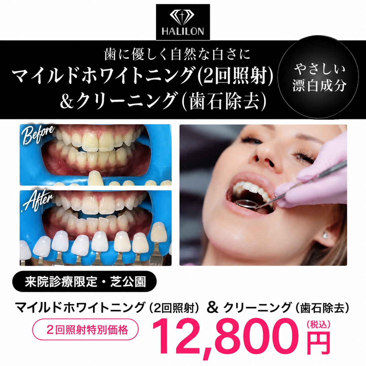 【HALILON Oral Studio】来院診療｜マイルドホワイトニングプラン(2回照射)